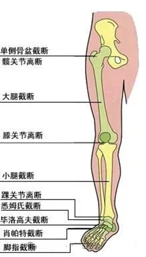 下肢截肢類型